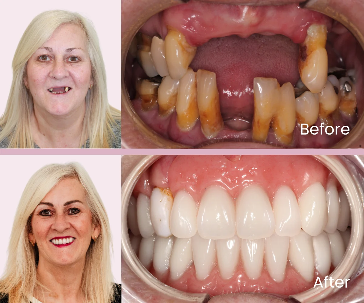 Full Smile Design Transformation