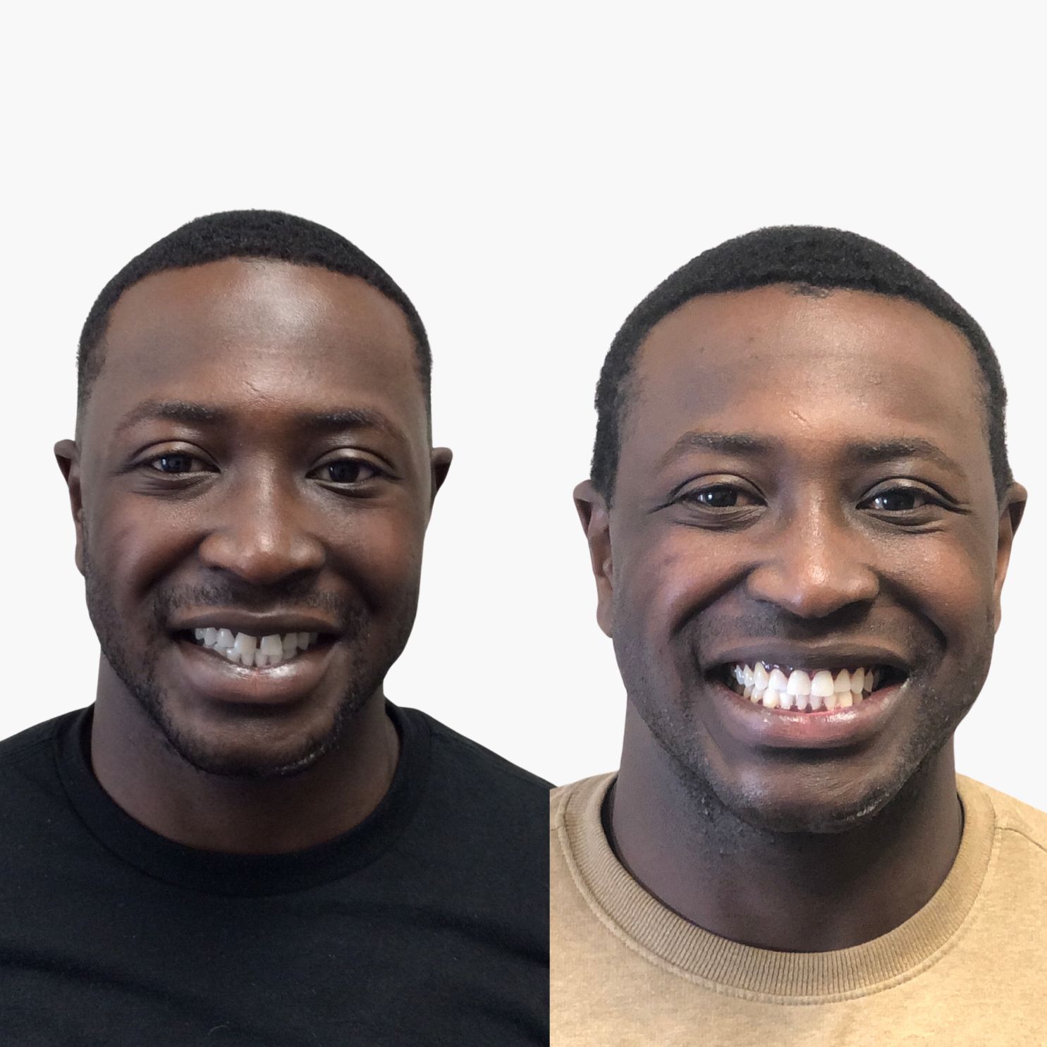 Invisalign Treatment Result