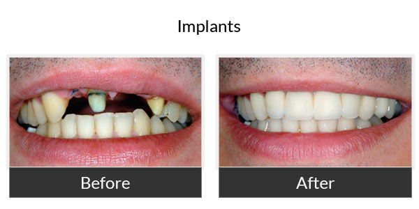 Implant Restoration Result