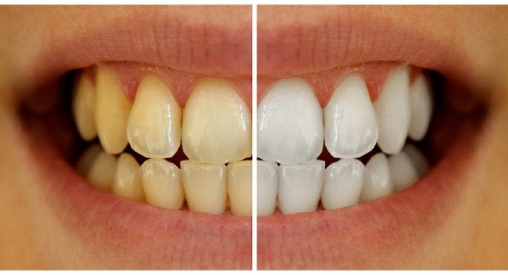 Whitening Result